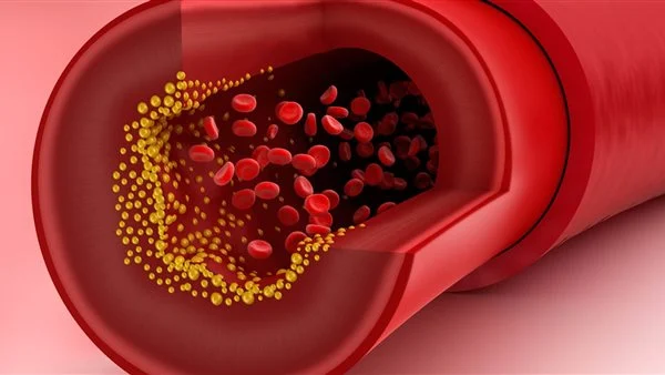 علامة ظاهرية تدل على الإصابة بارتفاع الكوليسترول في الدم