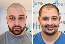 فراغات الذقن وزراعة الشعر